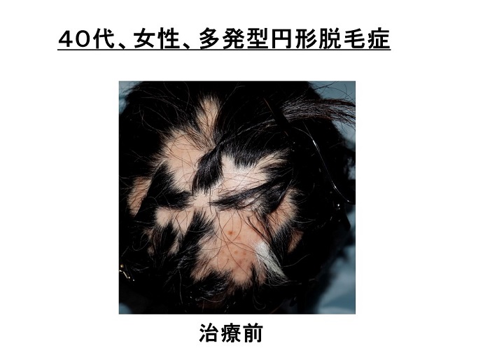 円形脱毛症　病院